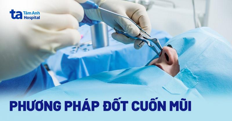 Hình ảnh minh họa quy trình đốt mạch máu mũi tại phòng khám bác sĩ